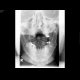 Fracture of the mandible: X-ray - Plain radiograph